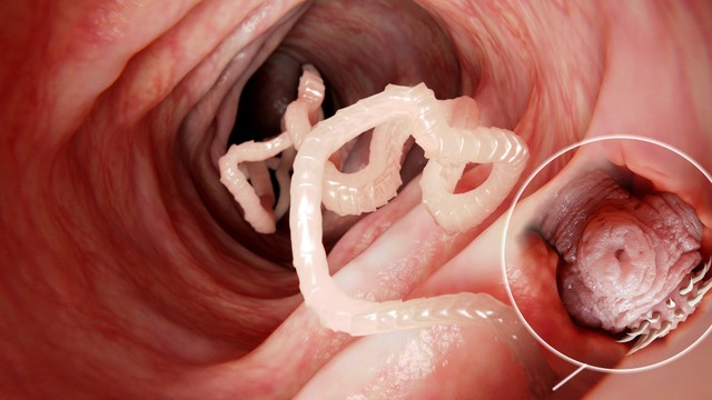 Sán dây là gì? Những thông tin bạn cần biết về sán dây