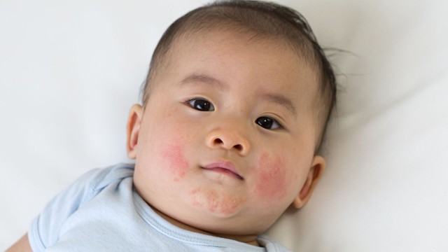 Sẩn ngứa ở trẻ em: Nguyên nhân, dấu hiệu và cách xử lý hiệu quả