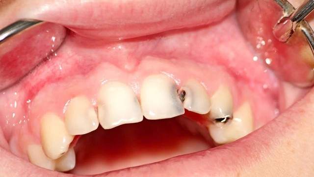 Sâu răng kiêng ăn gì để giảm đau và tránh nặng hơn?