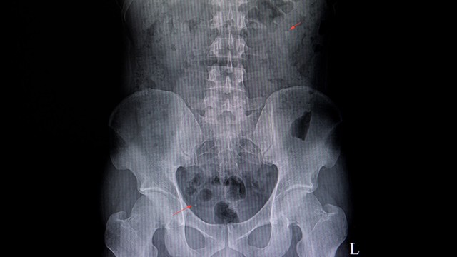 Sỏi niệu quản kiêng ăn gì? Những điều cần lưu ý