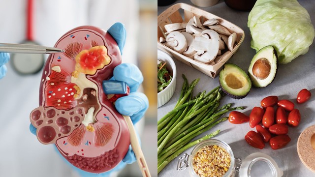 Sỏi thận nên ăn gì và kiêng gì? Chế độ ăn khi bị sỏi thận