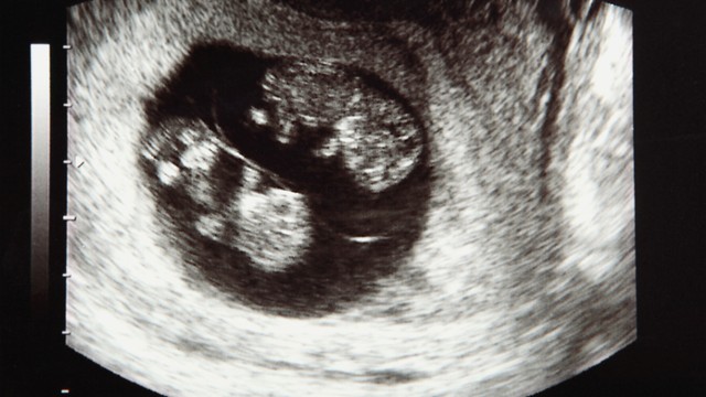 Song thai có nguy hiểm không? Những điều cha mẹ cần biết để chuẩn bị sớm