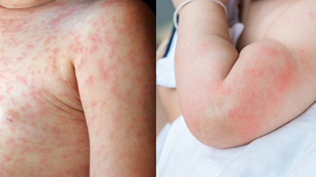 Sốt xuất huyết và dị ứng: Cách phân biệt và xử trí hiệu quả