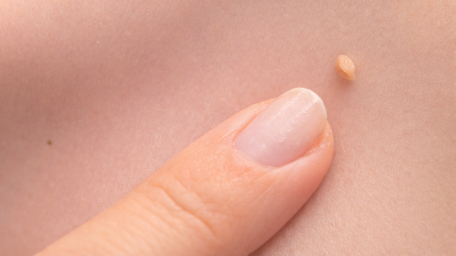 Sùi mào gà ở trẻ em: Nguyên nhân, dấu hiệu nhận biết và hướng xử trí