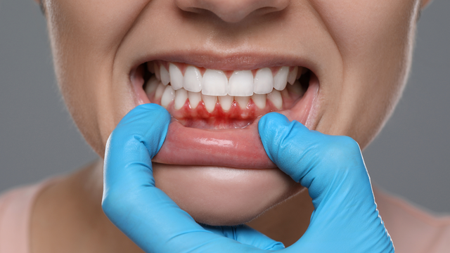 Sưng lợi răng cửa là gì? Nguyên nhân, cách điều trị và phòng ngừa