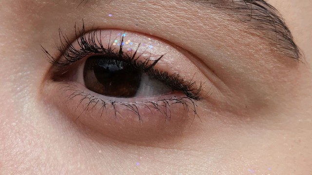 Sưng mí mắt dưới có nguy hiểm không? Nguyên nhân và hướng xử trí hiệu quả