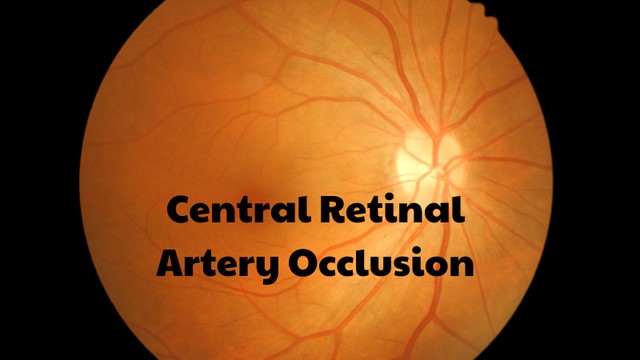 Tắc động mạch trung tâm võng mạc là tình trạng thế nào? Nguyên nhân và cách điều trị