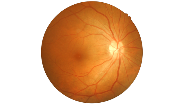 Tắc tĩnh mạch trung tâm võng mạc: Nhận biết sớm để bảo vệ thị lực