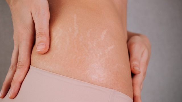 Tại sao bị rạn da ở tuổi dậy thì? Cách phòng ngừa rạn da đơn giản bạn nên biết