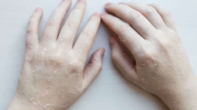 Tay bị lột da có nguy hiểm không? Cách xử lý và chăm sóc hiệu quả