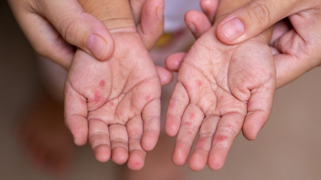 Tay chân miệng cấp độ 1 có lây không? Giải đáp và cách phòng ngừa