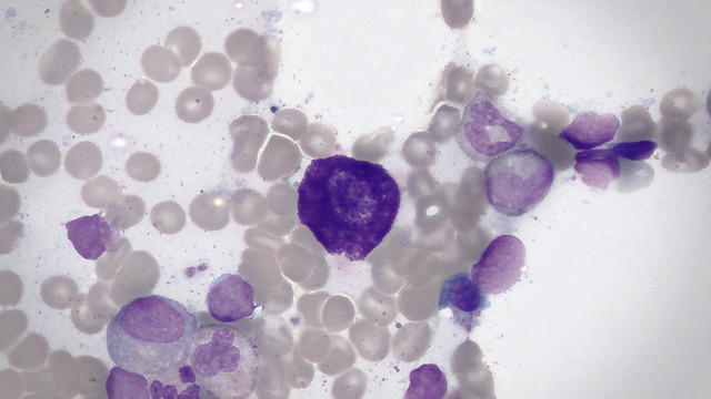 Tế bào Mast là gì và các biện pháp điều trị bệnh lý liên quan?