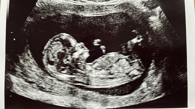 Thai 13 tuần có làm xét nghiệm NIPT được không? Lợi ích và lưu ý quan trọng