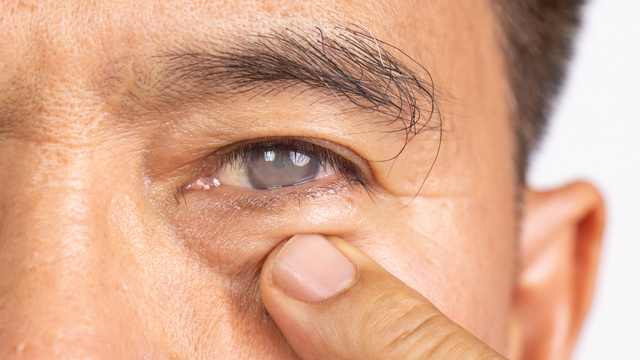 Thị lực 1/10 là cận bao nhiêu độ? Cận thị có nặng dần theo tuổi tác không?