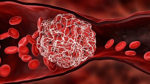 Thiếu máu cơ tim cục bộ nên ăn gì để bảo vệ sức khỏe tim mạch?