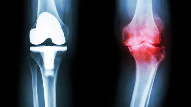 Thoái hóa khớp gối là gì? Nguyên nhân, triệu chứng và cách phòng ngừa