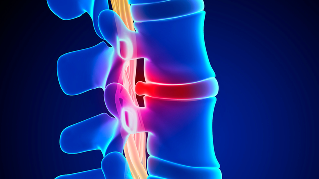 Thoát vị đĩa đệm L4 L5 là như thế nào? Biện pháp phòng ngừa thoát vị đĩa đệm L4 L5
