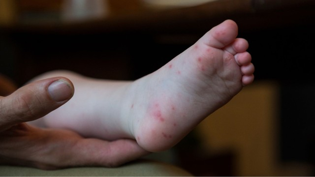 Thời tiết nóng làm tăng nguy cơ mắc bệnh tay chân miệng