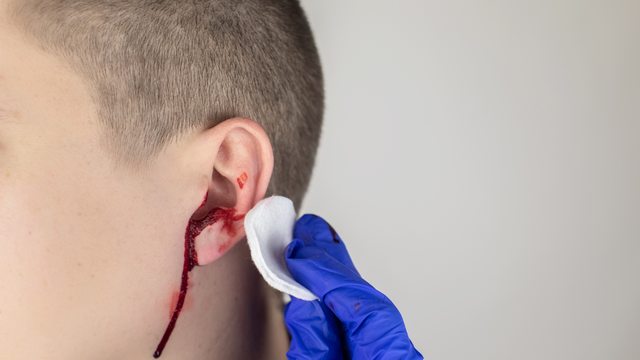 Thủng màng nhĩ có chảy máu nhiều không? Dấu hiệu cần lưu ý