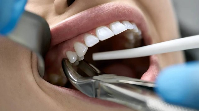 Thuốc tê nhổ răng có ảnh hưởng đến thai nhi không? 