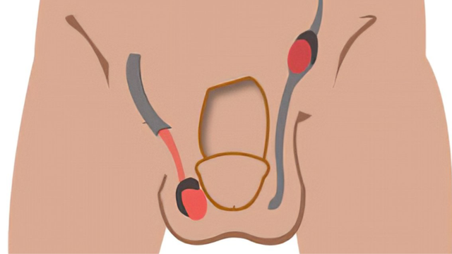 Tinh hoàn ẩn: Nguyên nhân, dấu hiệu và cách phòng ngừa