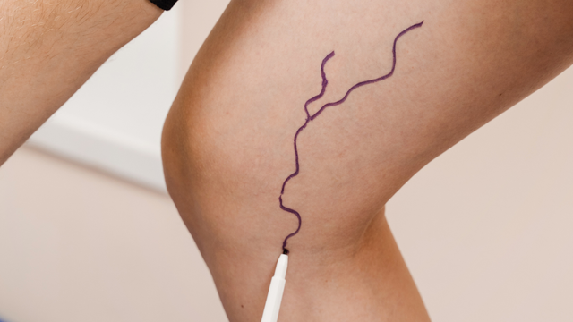 Tĩnh mạch hiển lớn: Cấu tạo, bệnh lý thường gặp và hướng xử lý