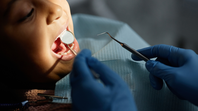 Trám răng sâu là gì? Cách phòng ngừa sâu răng hiệu quả