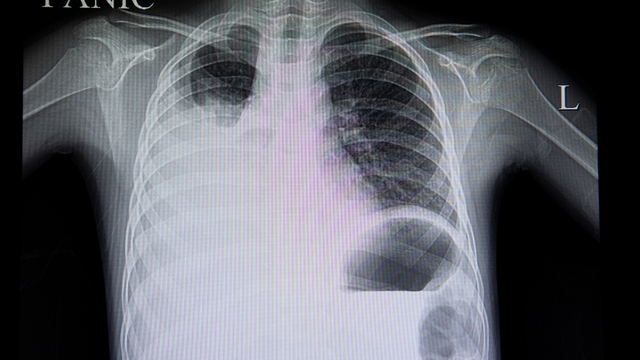 11 biến chứng tràn dịch màng phổi nguy hiểm có thể bạn chưa biết 