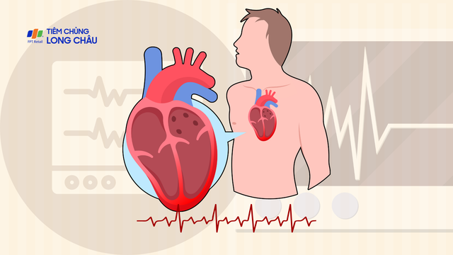 Tràn dịch màng tim là gì? Nguyên nhân, triệu chứng và phương pháp điều trị