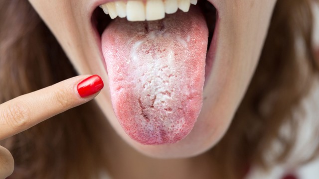 Trào ngược dạ dày lưỡi trắng là gì? Nguyên nhân và dấu hiệu nhận biết