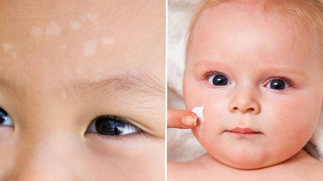 Trẻ sơ sinh bị lang trắng ở mặt do nguyên nhân gì?