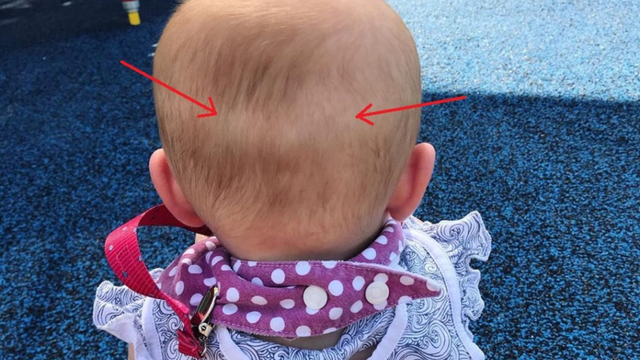 Trẻ sơ sinh bị lõm đầu phía sau có sao không? Cách khắc phục hiệu quả