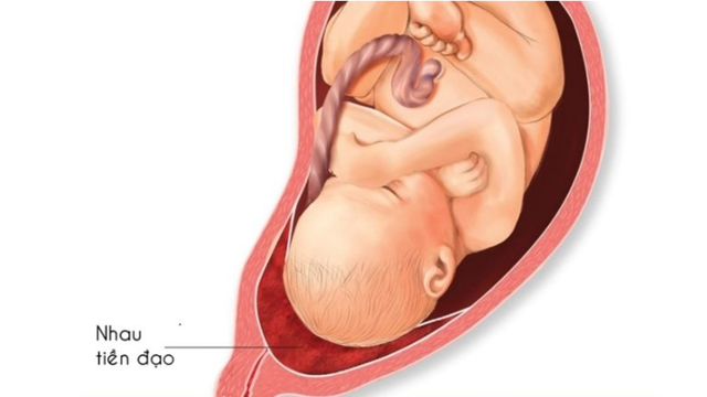 Tư thế nằm khi bị nhau tiền đạo và những lưu ý mẹ bầu cần biết