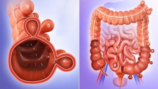 Túi thừa đại tràng là gì? Nguyên nhân, triệu chứng và cách điều trị hiệu quả