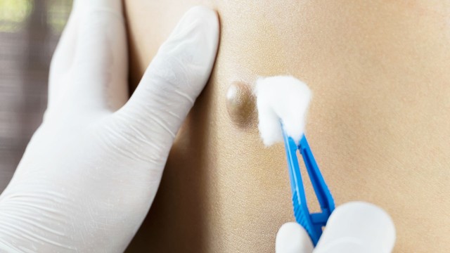 U bã đậu có nguy hiểm không? Giải đáp mức độ rủi ro và khi nào cần điều trị