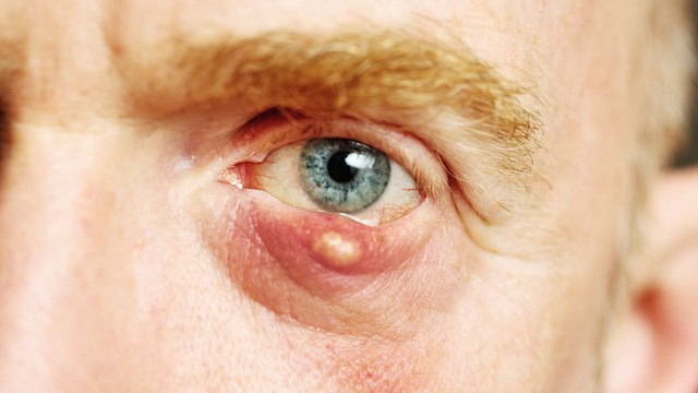 U bã đậu ở mí mắt: Dấu hiệu nhận biết và cách xử trí an toàn