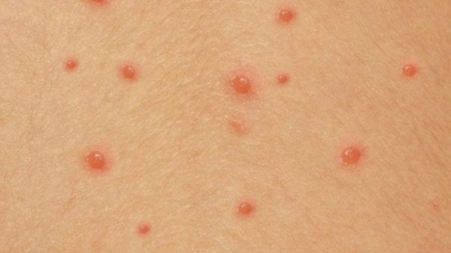 U mềm lây có tự khỏi không? Nguyên nhân, điều trị và phòng ngừa