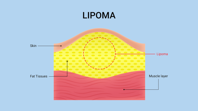 U mỡ có nguy hiểm không? Dấu hiệu nhận biết và hướng điều trị an toàn