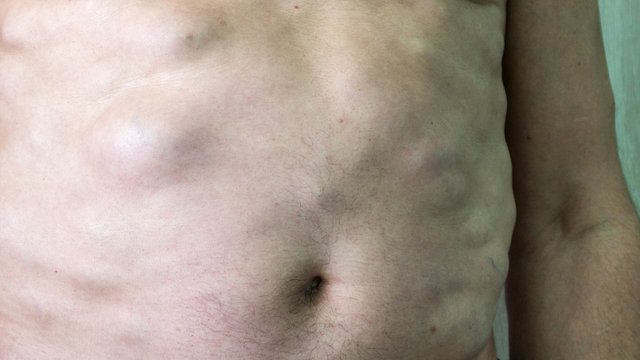 U mỡ ở bụng: Nguyên nhân, mức độ nguy hiểm và cách điều trị an toàn