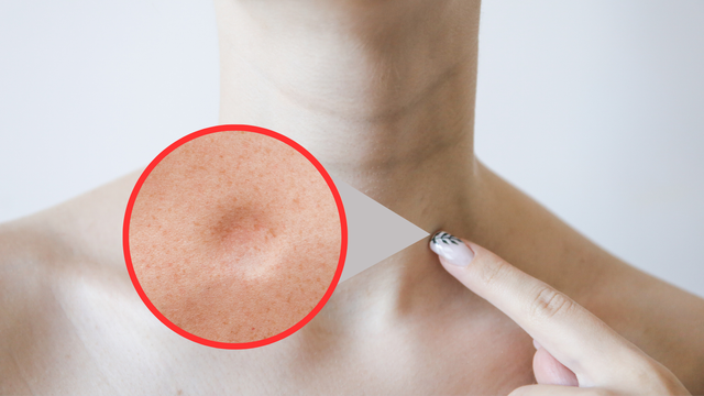 U mỡ ở cổ: Nguyên nhân, dấu hiệu nhận biết và cách điều trị an toàn