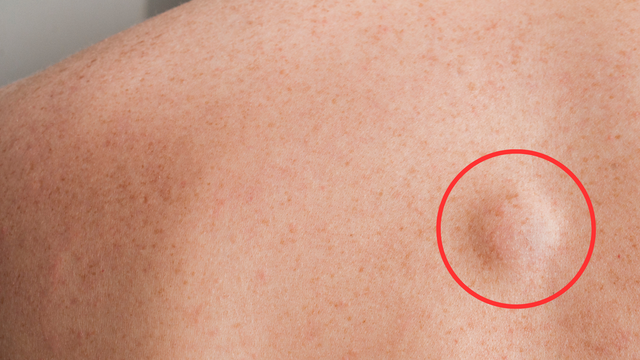 U mỡ ở lưng là gì? Nguyên nhân, dấu hiệu nhận biết và cách điều trị hiệu quả