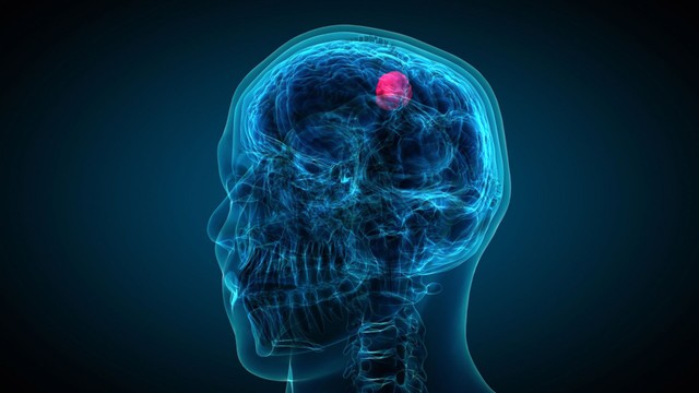 U não có di truyền không? Cách nhận biết nguy cơ