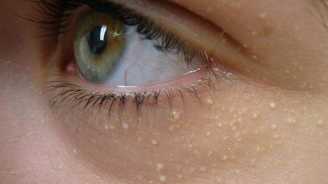 U xơ thần kinh mụn thịt: Nguyên nhân, triệu chứng và cách điều trị hiệu quả