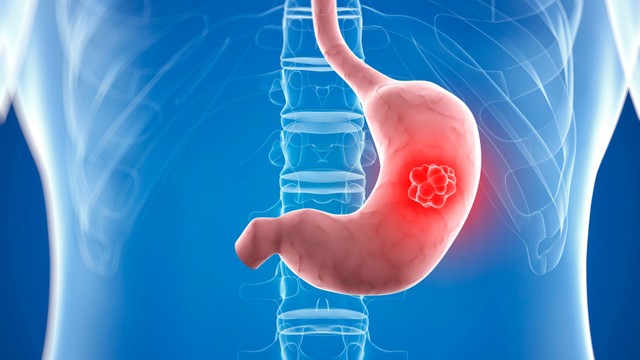 Ung thư dạ dày có lây không? Hiểu đúng để không hoang mang
