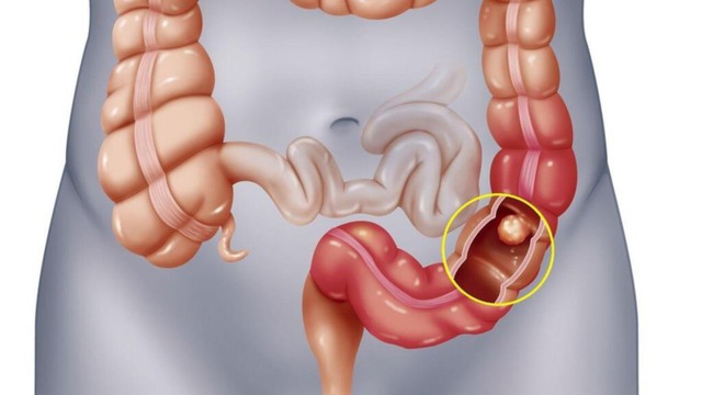 Ung thư đại tràng giai đoạn 3 sống được bao lâu? Những yếu tố ảnh hưởng đến tiên lượng sống