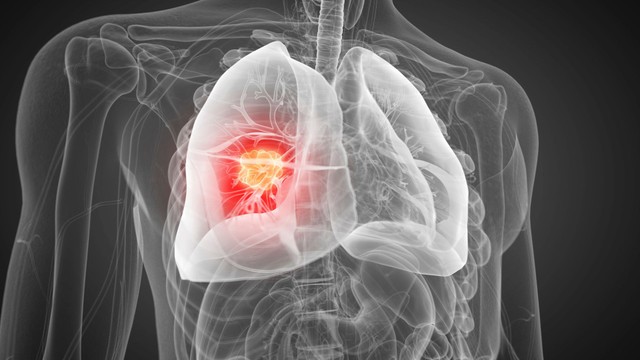 Ung thư phổi di căn xương sống được bao lâu? Tiên lượng và hướng chăm sóc