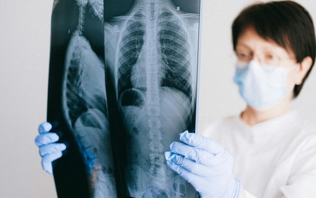 Ung thư phổi giai đoạn cuối sống được bao lâu và yếu tố ảnh hưởng