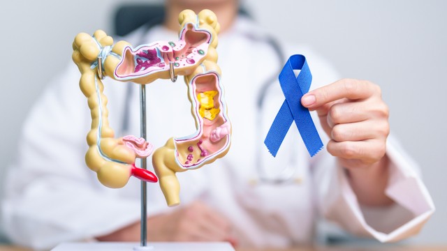 Ung thư ruột già là gì? Những vấn đề cần biết về ung thư ruột già