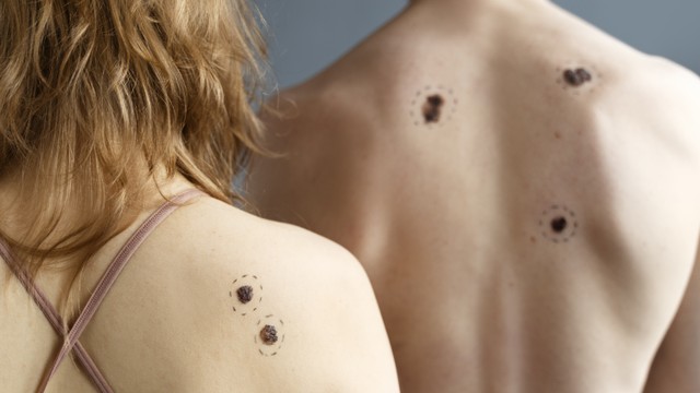 Ung thư sắc tố: Dấu hiệu nhận biết và cách phòng ngừa