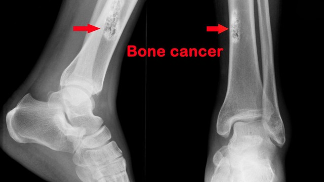 Ung thư xương giai đoạn cuối sống được bao lâu? Tiên lượng và chăm sóc